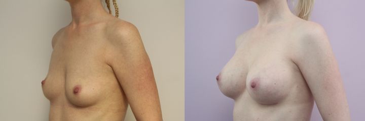 Zvětšení prsou - GIA Clinic s.r.o.