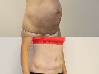 Abdominoplastika před a po - 867124