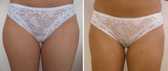 liposuk