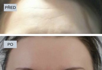 Botulotoxin - My Best Care s. r. o.