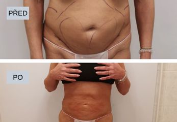 Liposukce - My Best Care s. r. o.