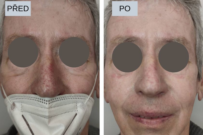Laserové odstranění rozšířených žilek před a po - 819909