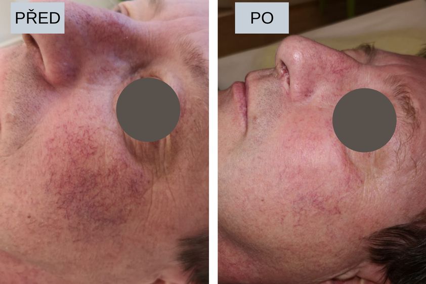 Laserové odstranění rozšířených žilek před a po - 819923