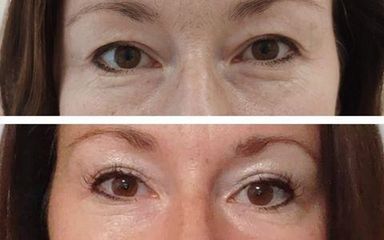 Operace očních víček - My Best Care s. r. o. - klinika estetické dermatologie a plastické chirurgie