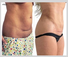 Liposukce - My Best Care s. r. o.