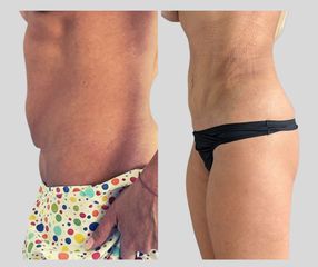Liposukce - My Best Care s. r. o.