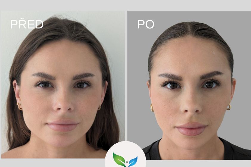 Botulotoxin před a po - 867235