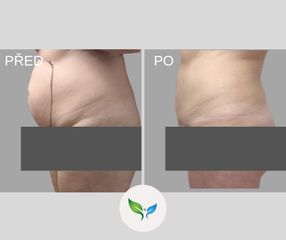 Liposukce - My Best Care s. r. o. - klinika estetické dermatologie a plastické chirurgie