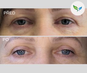 Blefaroplastika - My Best Care s. r. o. - klinika estetické dermatologie a plastické chirurgie