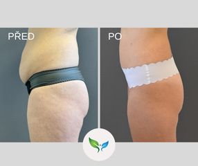 Miniabdominoplastika a liposukce