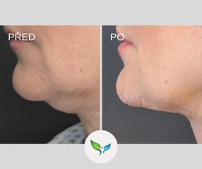Liposukce podbradku