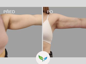 Liposukce před a po - 877628