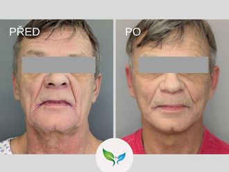 Facelift před a po - 877938