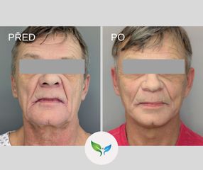 Facelift a Necklift