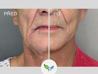 Facelift před a po - 877939