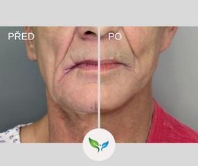 Facelift a Necklift 2