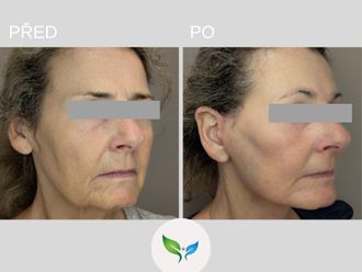 Facelift před a po - 877941