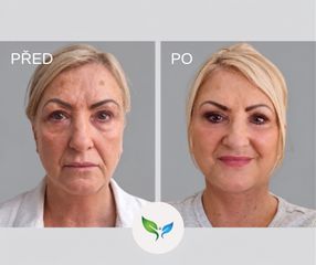 Deep plane facelift
