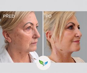 Deep plane facelift