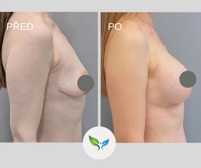 Modelace prsou s augmentací
