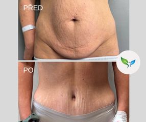 Abdominoplastika
