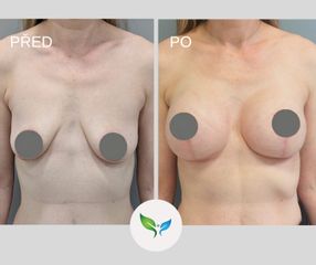 Modelace a augmentace prsou
