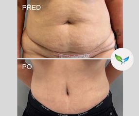 Abdominoplastika