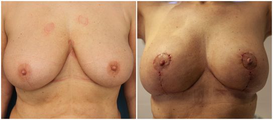 Modelace prsou - Klinické centrum ISCARE