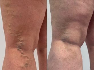 Sklerotizace před a po - 878281