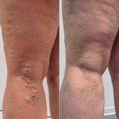 Žilní chirurgie ISCARE