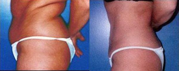 liposukce1 pred