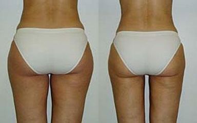 liposukce2 pred