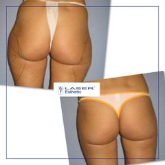 Liposukce - Klinika Laser Esthetic