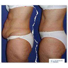 Abdominoplastika - Klinika Laser Esthetic