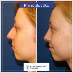 Rhinoplastika - Klinika Laser Esthetic