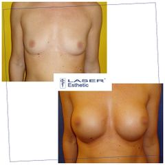 Zvětšení prsou - Klinika Laser Esthetic
