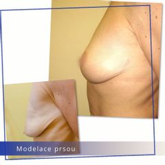 Modelace prsou - Klinika Laser Esthetic