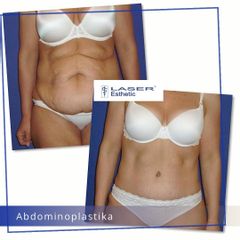 Abdominoplastika - Klinika Laser Esthetic