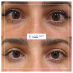 Odstranění kruhů pod očima - Klinika Laser Esthetic