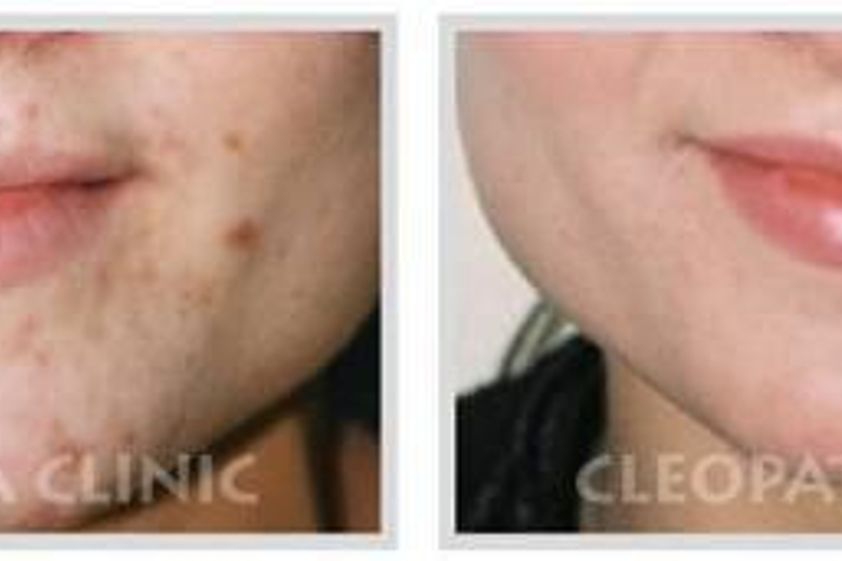 Laserová dermatologie před a po - 733625