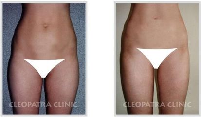 liposukce odsavani tuku 2