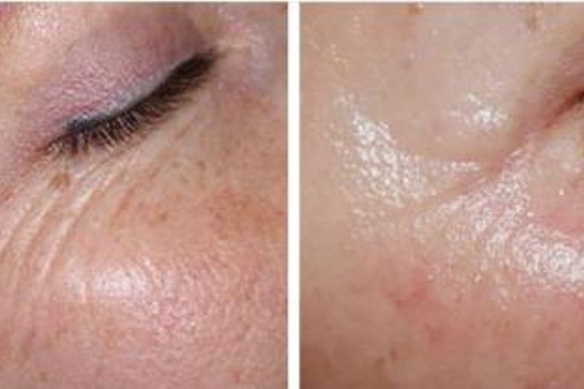 Fotorejuvenace IPL před a po - 726022