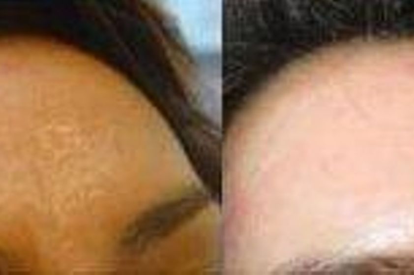 Microneedling před a po - 726052