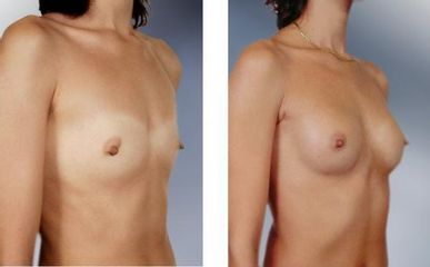 augment2