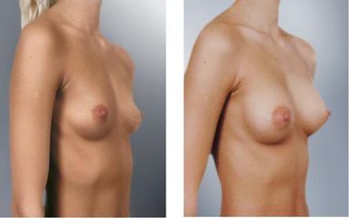 augment3
