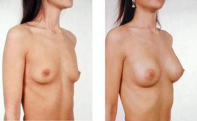 augment4