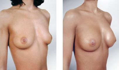 augment10