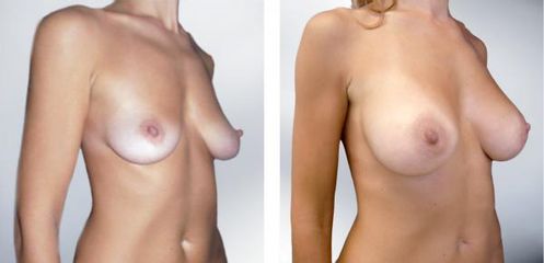 augment14