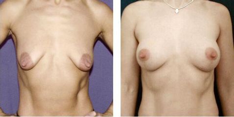 modelace odlozenaaugmentace