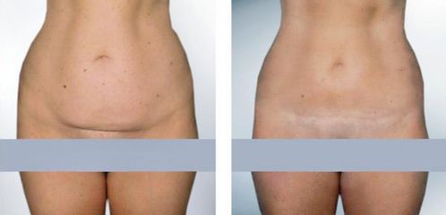 dolni miniabdominoplastika